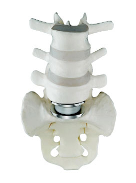 The Charite artificial disc is implanted between the L5 and the S1 vertebral levels.  Between the cobalt alloy endplates of the Charite artificial disc, is seen the polyethylene core.  The upper and lower surfaces of this core are spherical, and it is this design which provides for the non-constrained movement of the Charite artificial disc.  The goal in this case, is to limit the "wear and tear" on the L4/L5 disc space.