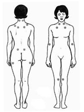 The nine paired tender points that comprise the 1990 American College of Rheumatology criteria for fibromyalgia.