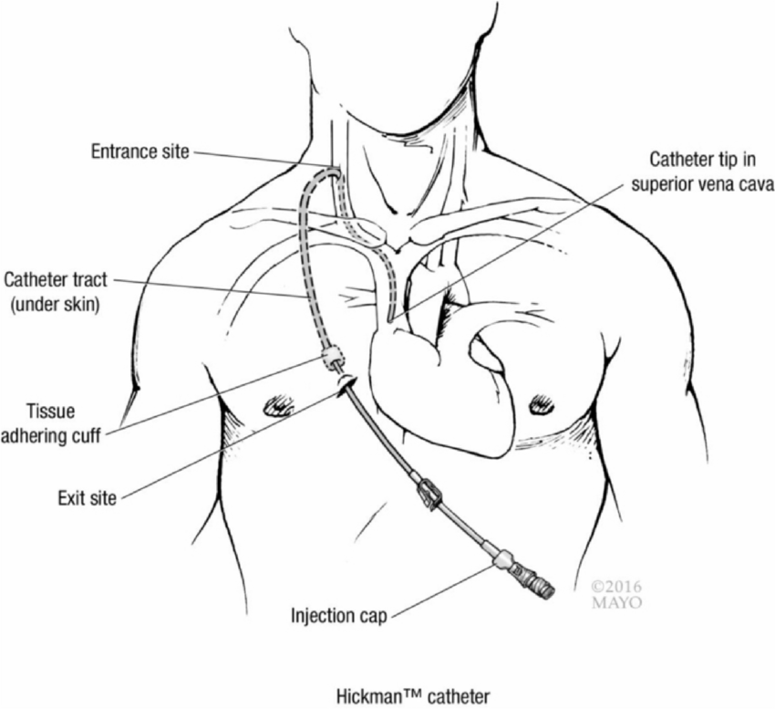 diagram of a currently used tunneled central venous catheter cvc very similar to the